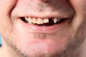 Close up of smiling male mouth with a broken tooth, missing front teeth